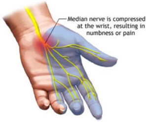 carpal_tunnel