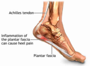 foot_pain