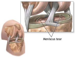 meniscus