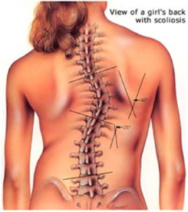 scoliosis